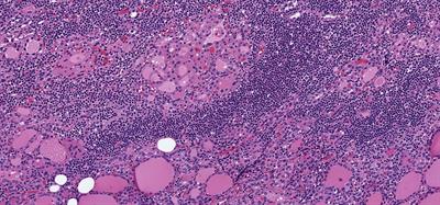 Oncocytic Change in Thyroid Pathology